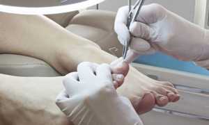 Онихолизис — лечение медикаментозными и народными средствами, физиотерапией и удалением ногтевой пластины