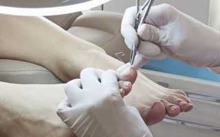 Онихолизис — лечение медикаментозными и народными средствами, физиотерапией и удалением ногтевой пластины