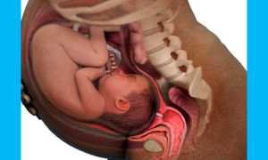 Можно ли забеременеть с кистой яичника