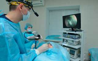 Аденотомия у детей и взрослых