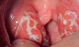 Атипичная скарлатина у детей: симптомы и лечение