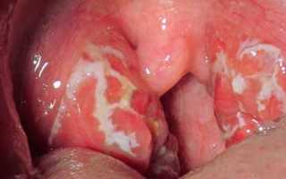 Атипичная скарлатина у детей: симптомы и лечение