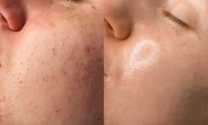 Лазерная шлифовка лица и тела