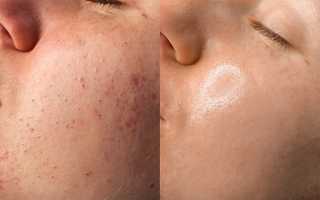 Лазерная шлифовка лица и тела