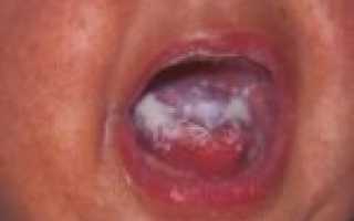 Чем опасна запущенная форма кандидоза для организма