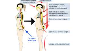 Последствия перелома копчика у женщин