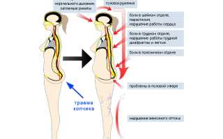 Последствия перелома копчика у женщин