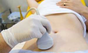 Полип в шейке матки — причины возникновения, симптомы, методы лечения