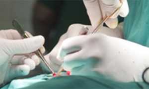 Асептический некроз головки тазобедренного сустава