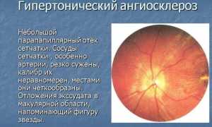 Гипертония 2 степени — симптомы, диагностика и методы лечения
