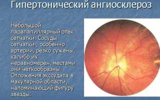 Гипертония 2 степени — симптомы, диагностика и методы лечения