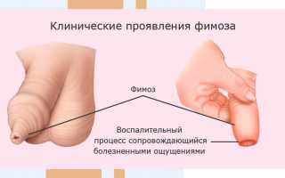 Как вылечить фимоз у детей без операции? Просто и эффективно