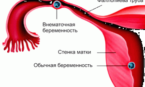 Тест на внематочную беременность