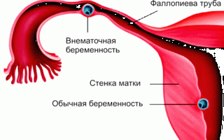 Тест на внематочную беременность