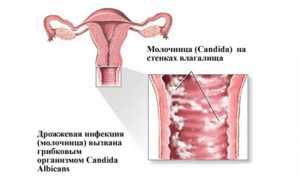 Можно ли иметь интимную близость при молочнице?