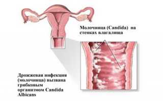Можно ли иметь интимную близость при молочнице?