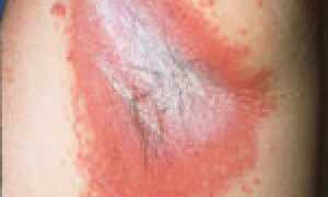 Особенности применения препарата Лотримин для лечения грибка