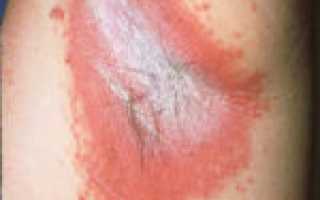 Особенности применения препарата Лотримин для лечения грибка