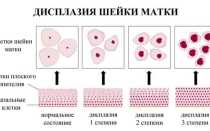 Противопоказан ли секс при дисплазии матки?