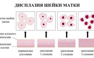Противопоказан ли секс при дисплазии матки?