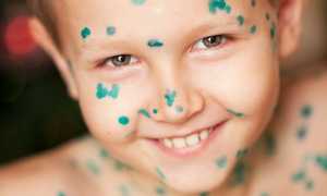 Ветряная оспа. Лечим зеленкой?