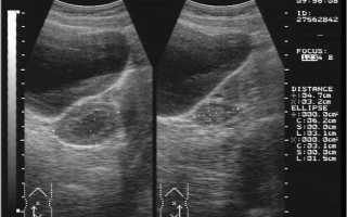 Стоит ли осуществлять лечение оофорита народными средствами?