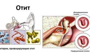 Симптомы отита у детей — основные признаки и виды заболевания
