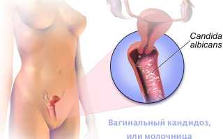Причины молочницы после овуляции