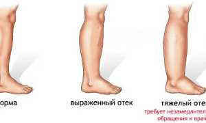 Отекают ноги при беременности