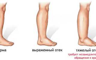 Отекают ноги при беременности