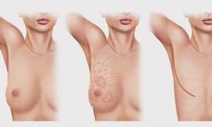 Лечение рака груди