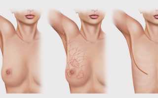 Лечение рака груди