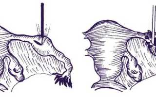 Как проводится сальпинготомия при внематочной беременности?