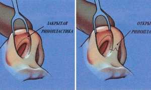 Что такое ринопластика