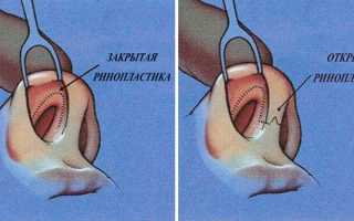 Что такое ринопластика