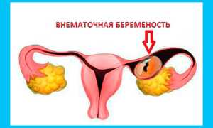 Воспаление придатков: можно ли забеременеть при аднексите
