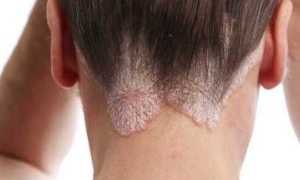 Способ лечения грибка препаратом Микозорал