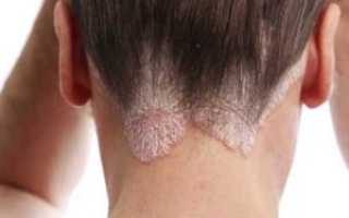 Способ лечения грибка препаратом Микозорал