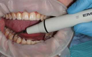 Может ли проводиться ультразвуковая чистка зубов при беременности?