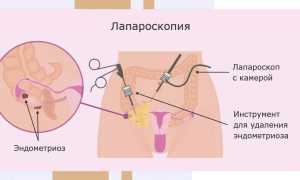 Беременность после лапароскопии