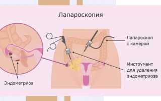 Беременность после лапароскопии