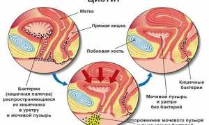 Цистит в острой форме при беременности: способы борьбы с патологией