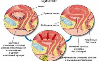 Цистит в острой форме при беременности: способы борьбы с патологией