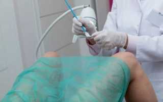 Особенности взятия мазка на гонорею