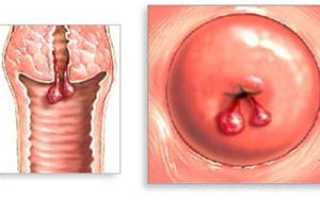 Лечения кист шейки матки народными средствами: способы и правила