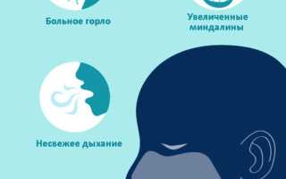 Хронический тонзиллит: симптомы и лечение у взрослых и детей