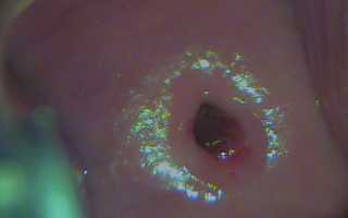 Синюшная шейка матки: причины и лечение