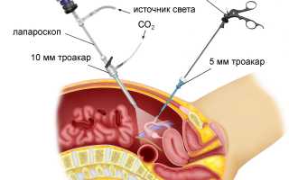 Когда ждать овуляцию после проведенной лапароскопии?