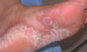 Применение препарата Резорцин как один из способов борьбы с грибком