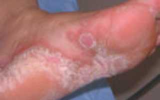 Применение препарата Резорцин как один из способов борьбы с грибком